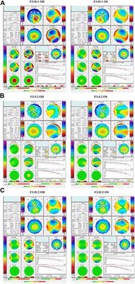 Clinical and genetic analysis VSX1 variants among families with keratoconus in northwest China